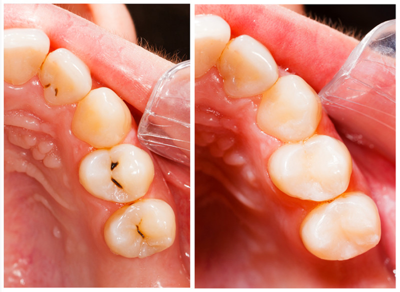 Fillings Alpharetta, GA