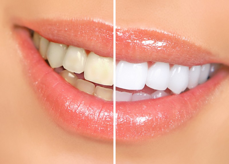 Teeth Whitening Alpharetta, GA