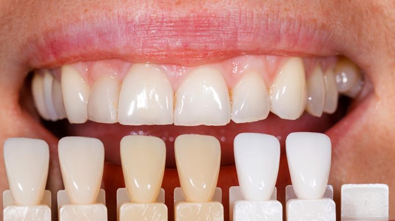 Veneers Alpharetta, GA
